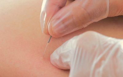 Managing Anxiety Naturally in Oviedo: The Growing Demand for Acupuncture and Integrative Therapies