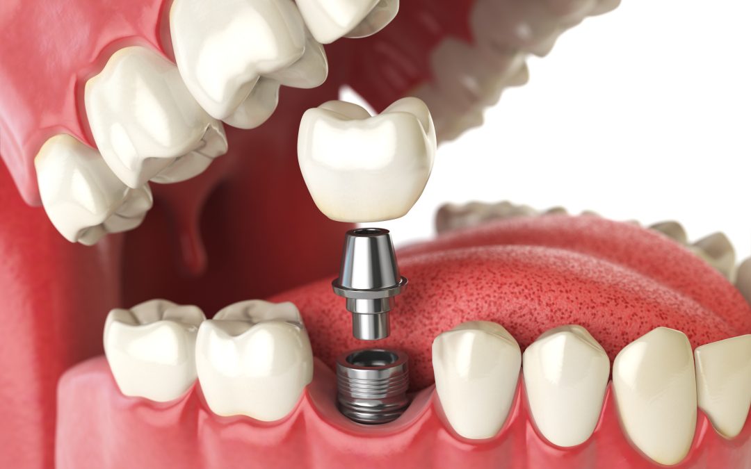LifeChanging Smiles Start with Teeth Implants Baton Rouge LA Patients Recommend