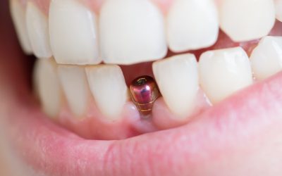Achieve a Natural Look and Strong Teeth Using Veneers Isle Of Palms Sc Solutions