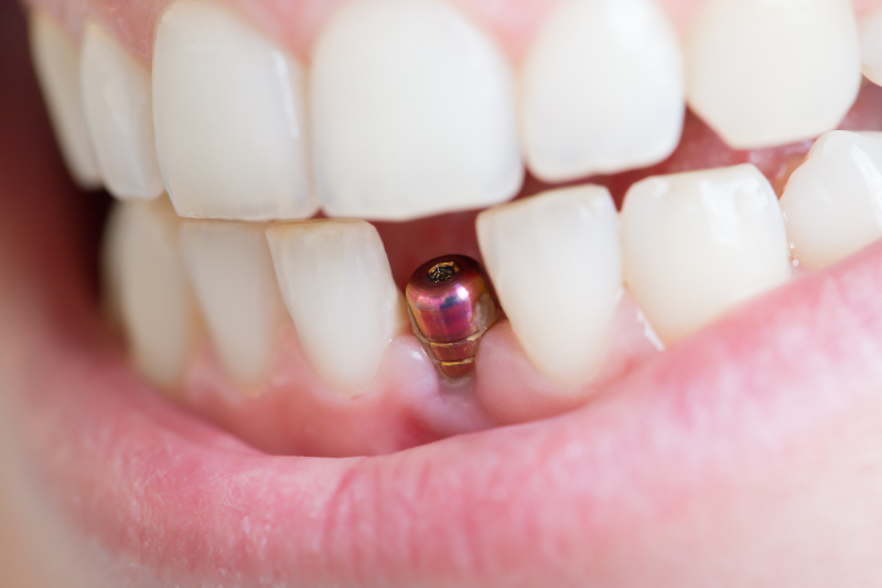 Achieve a Natural Look and Strong Teeth Using Veneers Isle Of Palms Sc Solutions